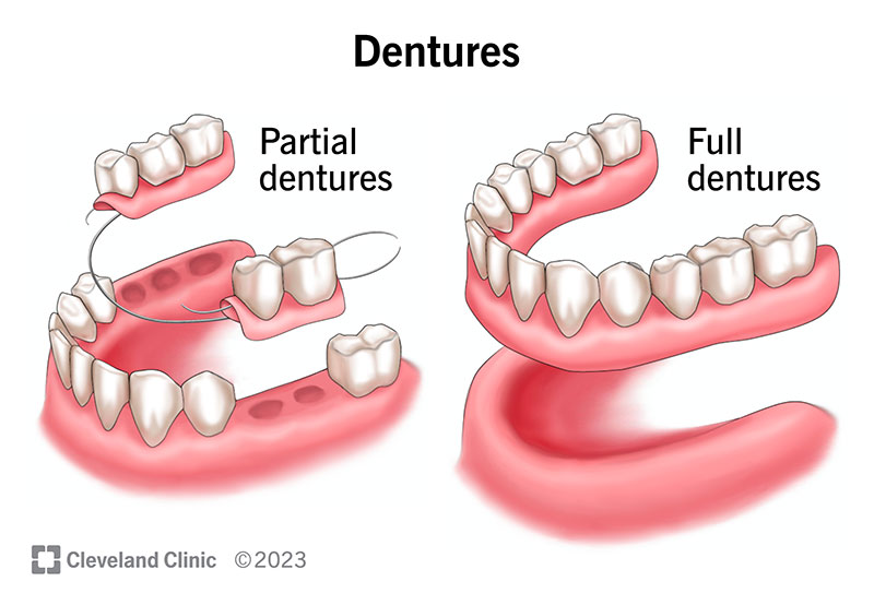 Dentures