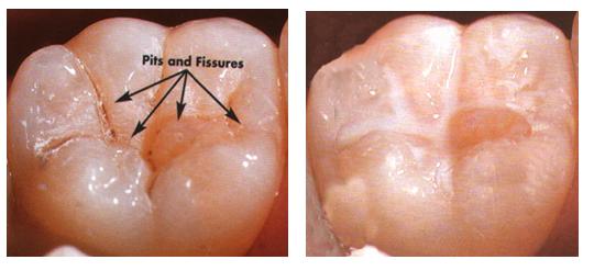 Fissure sealants
