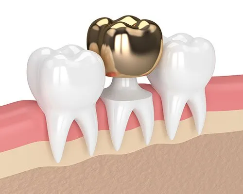 Laboratory-Made Crowns