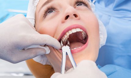 Wisdom teeth extractions